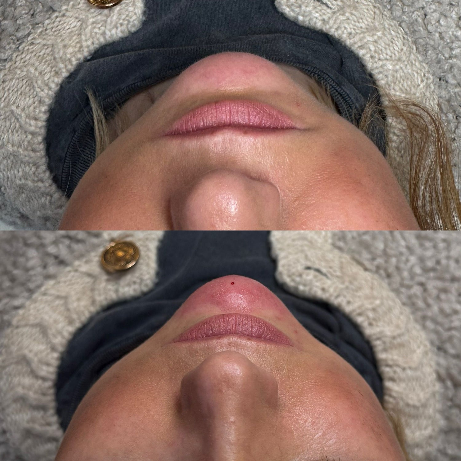 The Aesthetics Room Bromsgrove image of treatments provided chin filler